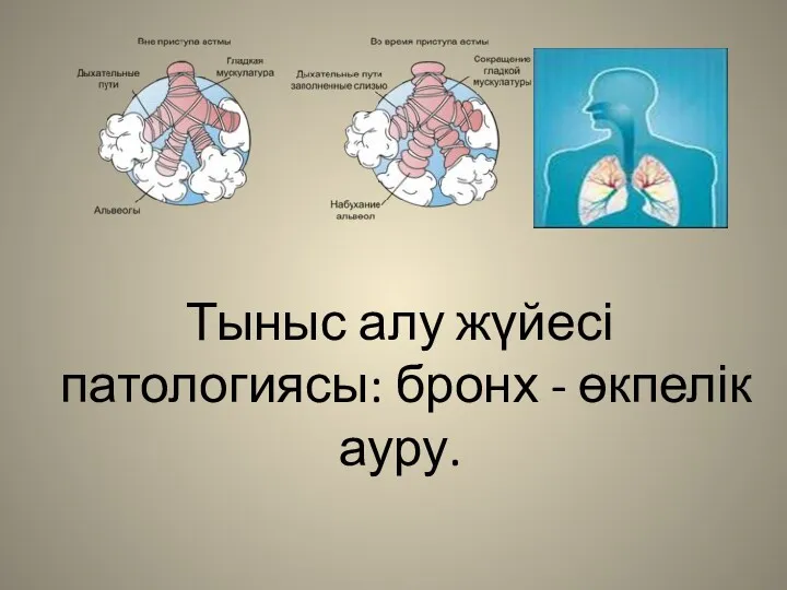 Тыныс алу жүйесі патологиясы: бронх - өкпелік ауру.