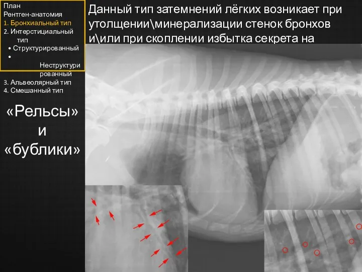 Данный тип затемнений лёгких возникает при утолщении\минерализации стенок бронхов и\или при скоплении избытка