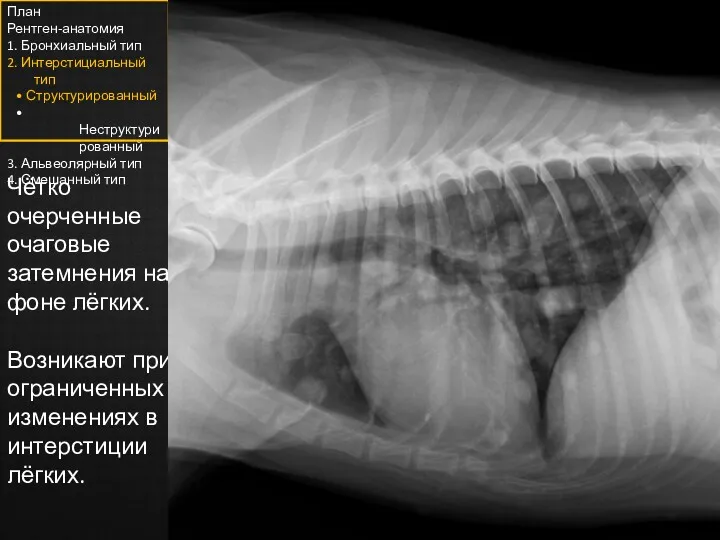 Чётко очерченные очаговые затемнения на фоне лёгких. Возникают при ограниченных изменениях в интерстиции лёгких.