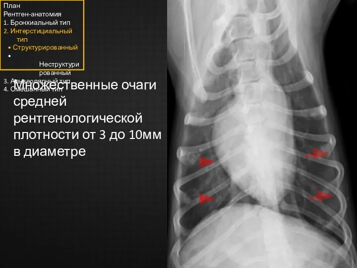 Множественные очаги средней рентгенологической плотности от 3 до 10мм в диаметре