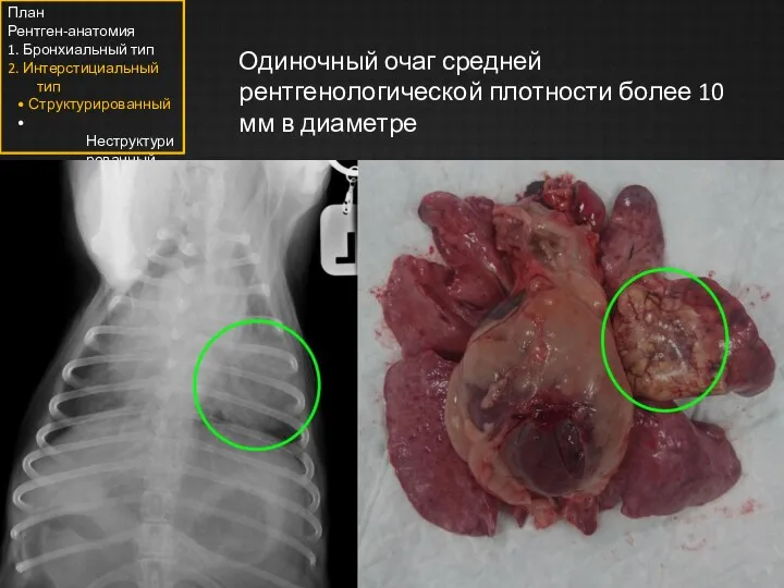 Одиночный очаг средней рентгенологической плотности более 10 мм в диаметре