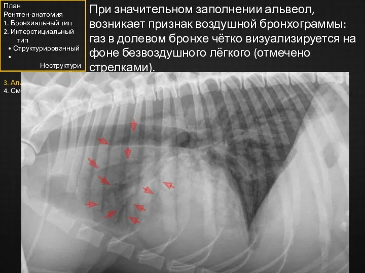 При значительном заполнении альвеол, возникает признак воздушной бронхограммы: газ в