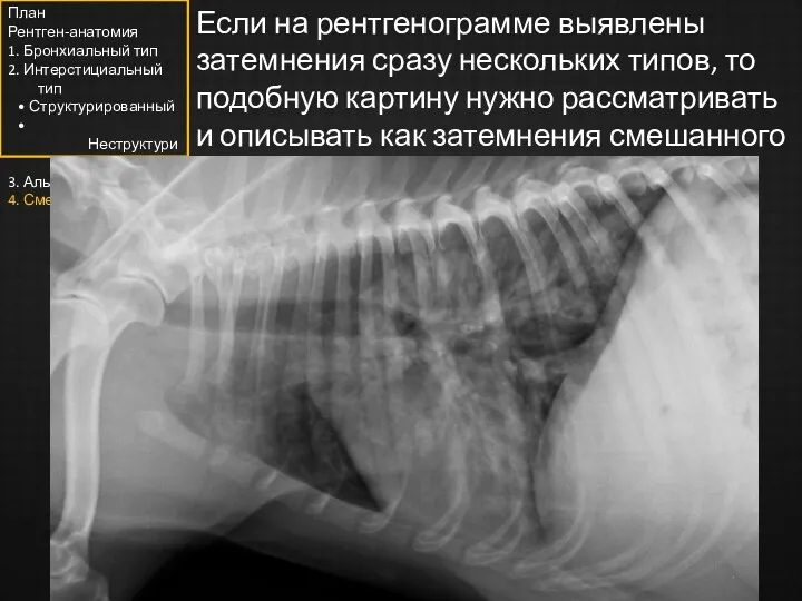 Если на рентгенограмме выявлены затемнения сразу нескольких типов, то подобную