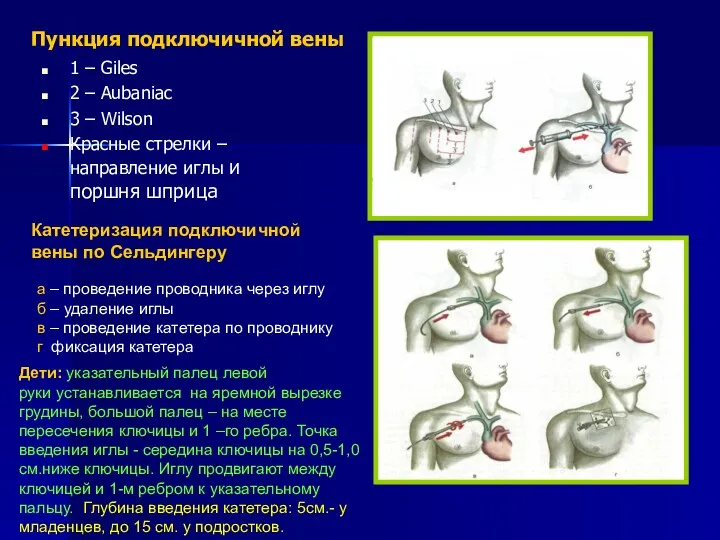 Пункция подключичной вены 1 – Giles 2 – Aubaniac 3