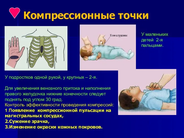 Компрессионные точки У маленьких детей 2-я пальцами. У подростков одной