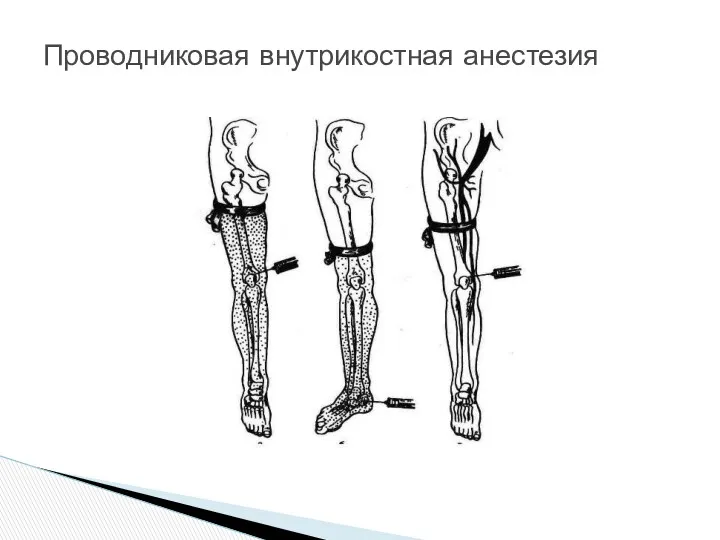 Проводниковая внутрикостная анестезия