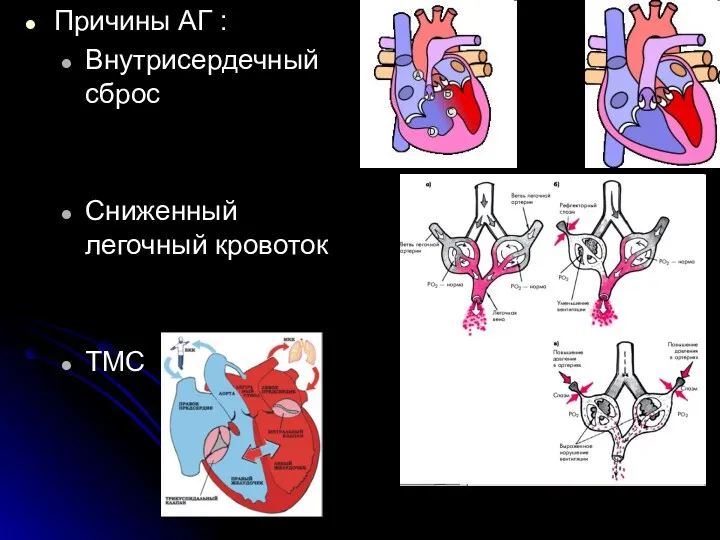 Причины АГ : Внутрисердечный сброс Сниженный легочный кровоток ТМС