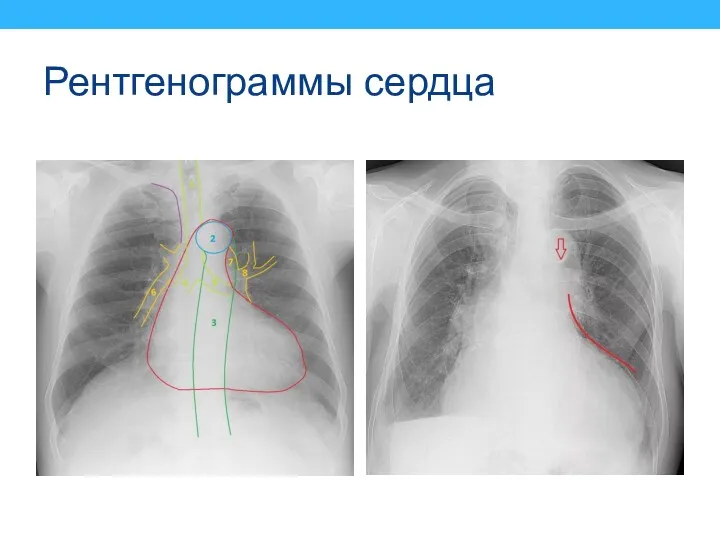 Рентгенограммы сердца