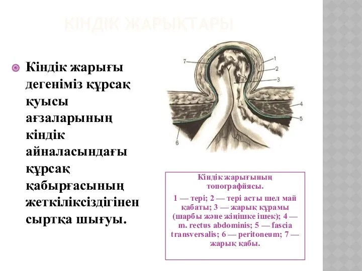 КІНДІК ЖАРЫҚТАРЫ Кіндік жарығының топографйясы. 1 — тері; 2 — тері асты шел