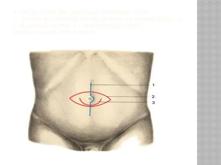 РАЗРЕЗЫ КОЖИ ПРИ ОПЕРАЦИИ ПУПОЧНЫХ ГРЫЖ. 1 — РАЗРЕЗ ПО