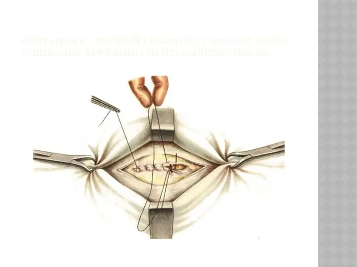 ОПЕРАЦИЯ ПУПОЧНОЙ ГРЫЖИ ПО СПОСОБУ МЕЙО. УШИВАНИЕ БРЮШИНЫ НЕПРЕРЫВНЫМ ШВОМ.