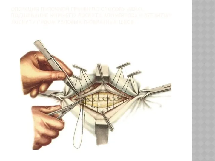 ОПЕРАЦИЯ ПУПОЧНОЙ ГРЫЖИ ПО СПОСОБУ МЕЙО. ПОДШИВАНИЕ НИЖНЕГО ЛОСКУТА АПОНЕВРОЗА К ВЕРХНЕМУ ЛОСКУТУ