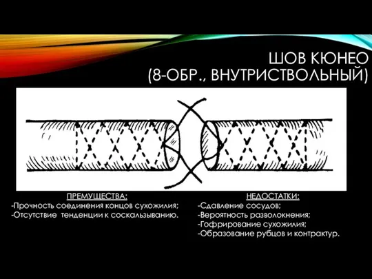 ШОВ КЮНЕО (8-ОБР., ВНУТРИСТВОЛЬНЫЙ) ПРЕМУЩЕСТВА: -Прочность соединения концов сухожилия; -Отсутствие