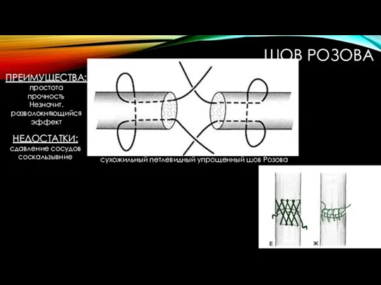 ШОВ РОЗОВА ПРЕИМУЩЕСТВА: простота прочность Незначит.разволокняющийся эффект НЕДОСТАТКИ: сдавление сосудов соскальзывние сухожильный петлевидный упрощенный шов Розова
