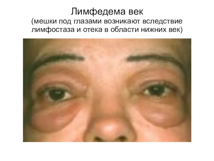 Лимфедема век (мешки под глазами возникают вследствие лимфостаза и отека в области нижних век)
