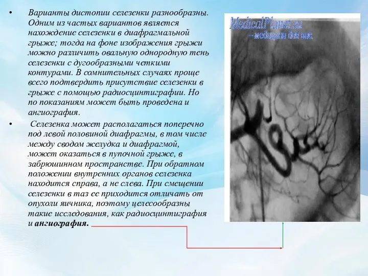 Варианты дистопии селезенки разнообразны. Одним из частых вариантов является нахождение