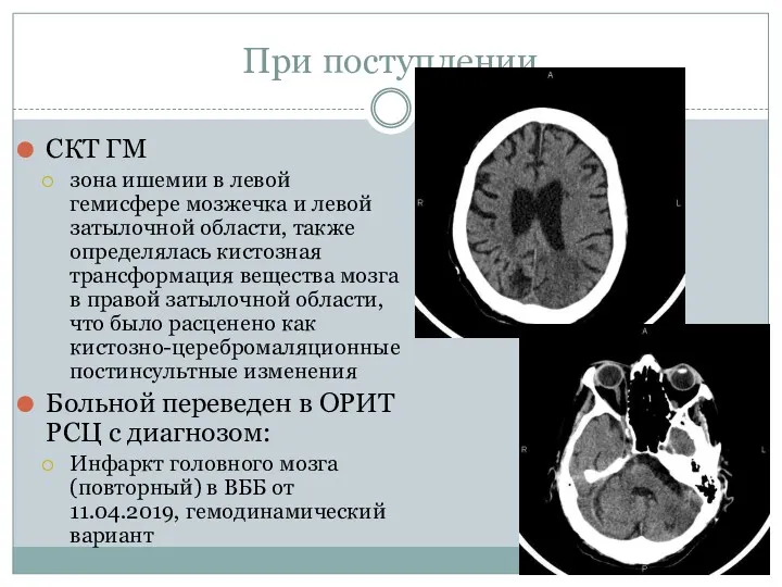 При поступлении СКТ ГМ зона ишемии в левой гемисфере мозжечка