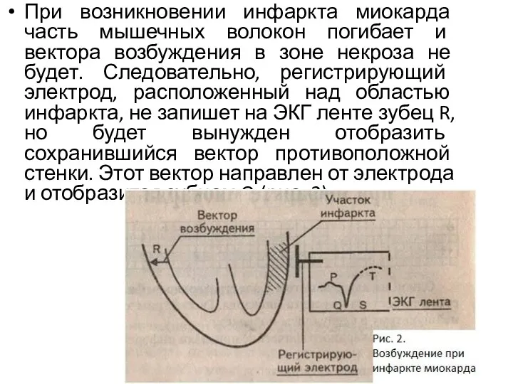 При возникновении инфаркта миокарда часть мышечных волокон погибает и вектора