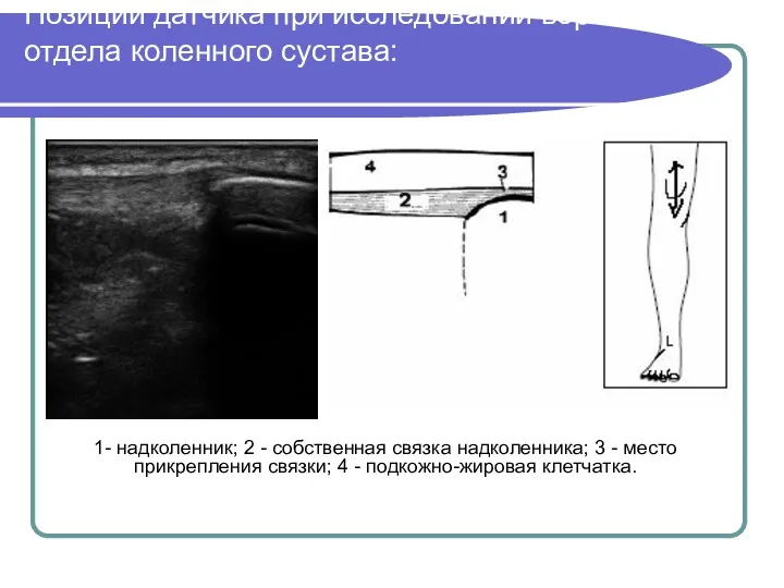 Позиции датчика при исследовании верхнего отдела коленного сустава: 1- надколенник;