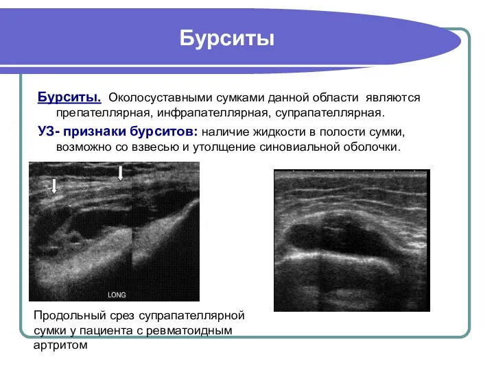 Бурситы Бурситы. Околосуставными сумками данной области являются препателлярная, инфрапателлярная, супрапателлярная.