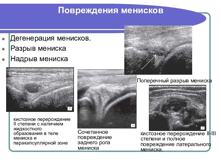 Повреждения менисков Дегенерация менисков. Разрыв мениска Надрыв мениска Сочетанное повреждение