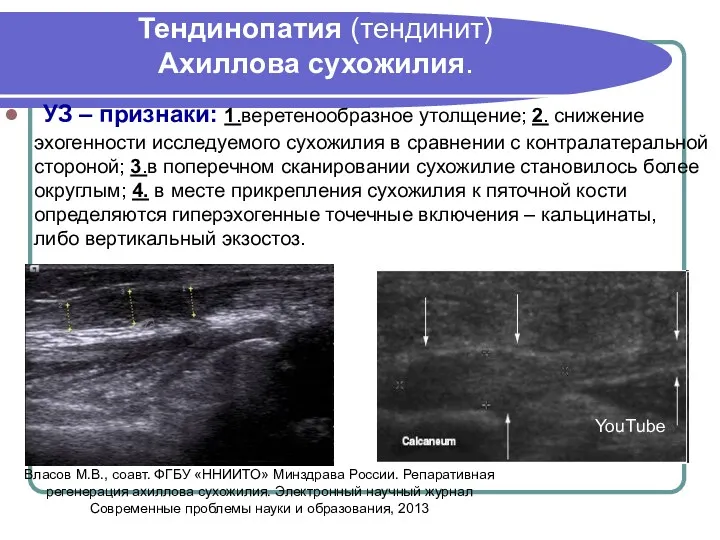 Тендинопатия (тендинит) Ахиллова сухожилия. УЗ – признаки: 1.веретенообразное утолщение; 2.