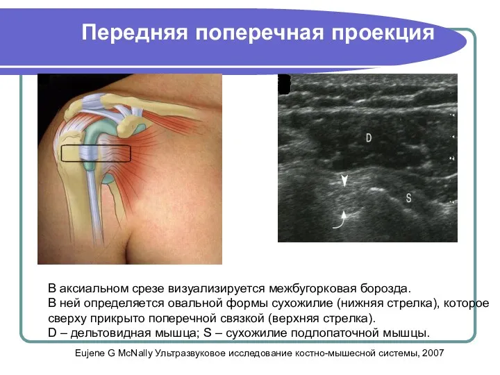 Передняя поперечная проекция В аксиальном срезе визуализируется межбугорковая борозда. В