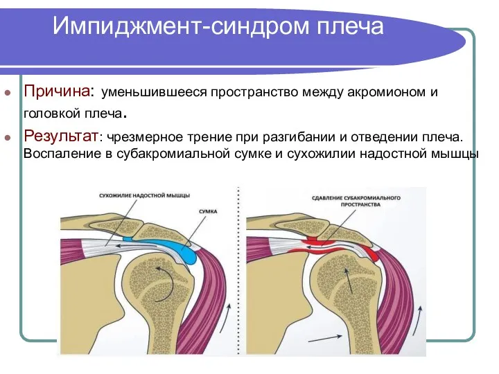 Импиджмент-синдром плеча Причина: уменьшившееся пространство между акромионом и головкой плеча.