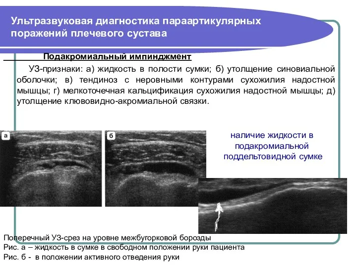 Ультразвуковая диагностика параартикулярных поражений плечевого сустава Подакромиальный импинджмент УЗ-признаки: а)