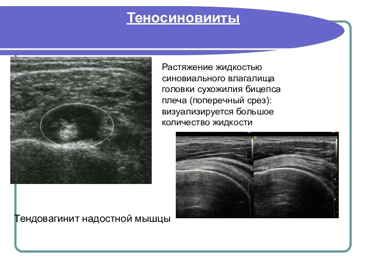 Теносиновииты Растяжение жидкостью синовиального влагалища головки сухожилия бицепса плеча (поперечный