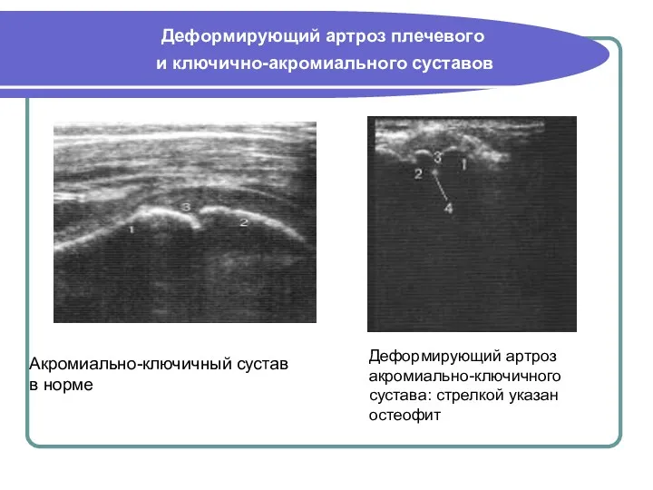 Акромиально-ключичный сустав в норме Деформирующий артроз акромиально-ключичного сустава: стрелкой указан