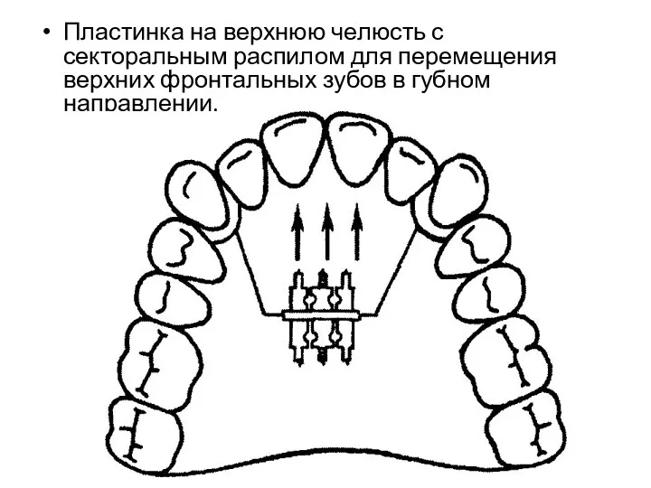 Пластинка на верхнюю челюсть с секторальным распилом для перемещения верхних фронтальных зубов в губном направлении.