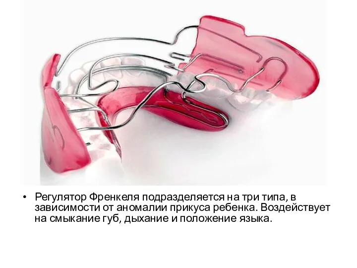 Регулятор Френкеля подразделяется на три типа, в зависимости от аномалии прикуса ребенка. Воздействует