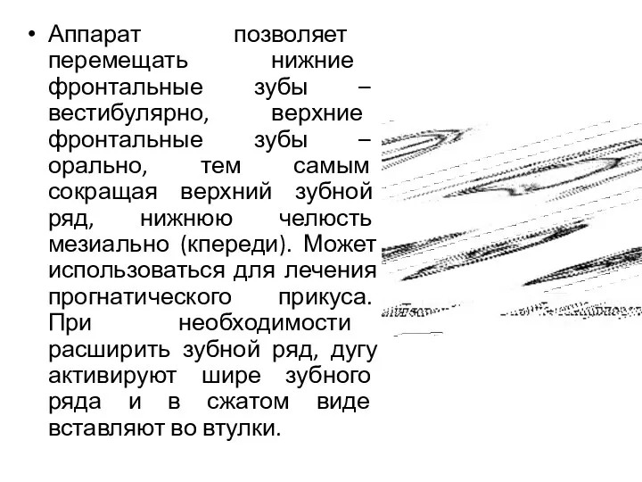 Аппарат позволяет перемещать нижние фронтальные зубы – вестибулярно, верхние фронтальные зубы – орально,