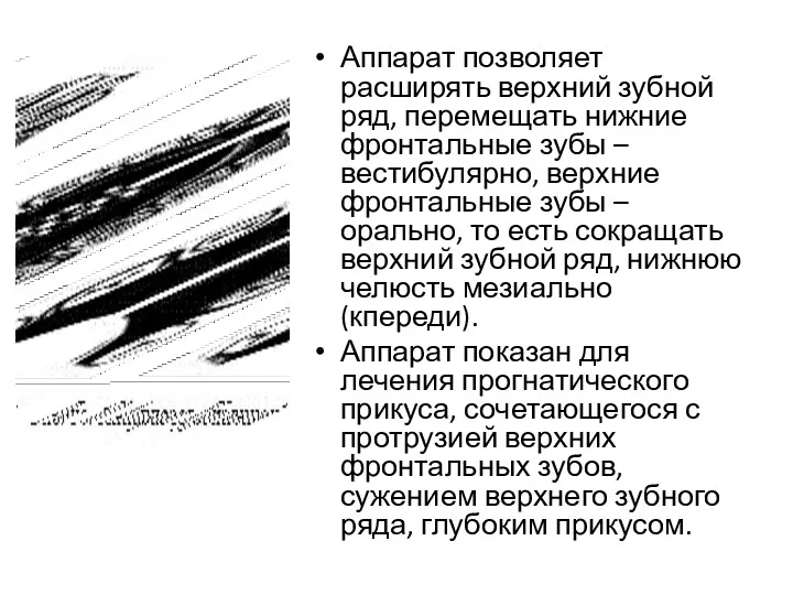 Аппарат позволяет расширять верхний зубной ряд, перемещать нижние фронтальные зубы