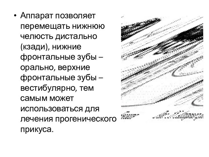 Аппарат позволяет перемещать нижнюю челюсть дистально (кзади), нижние фронтальные зубы