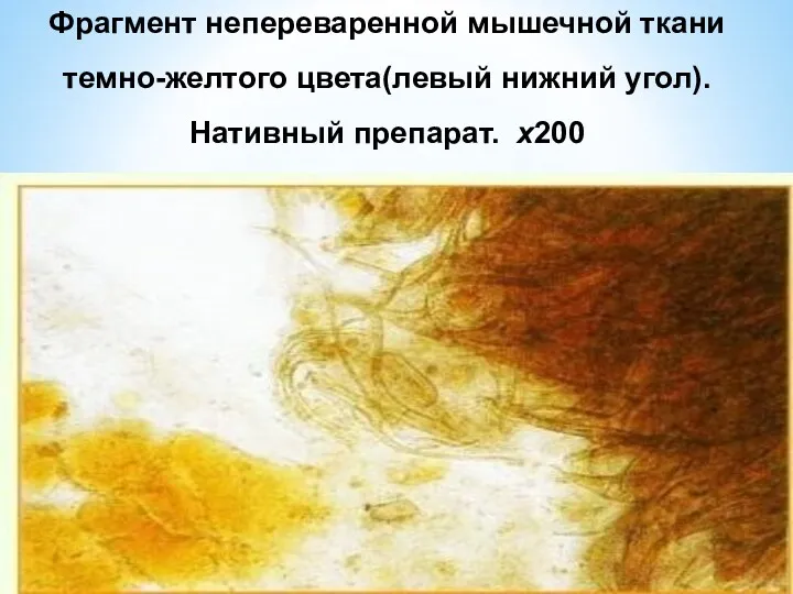 Фрагмент непереваренной мышечной ткани темно-желтого цвета(левый нижний угол). Нативный препарат. х200