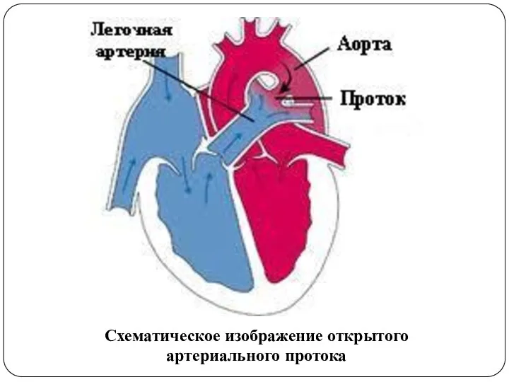 Схематическое изображение открытого артериального протока