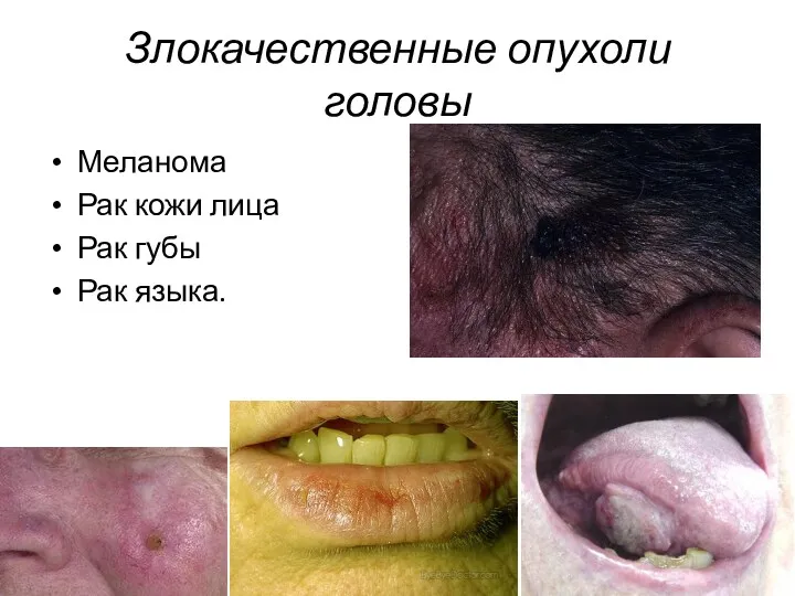 Злокачественные опухоли головы Меланома Рак кожи лица Рак губы Рак языка.