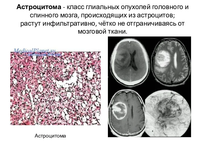 Астроцитома - класс глиальных опухолей головного и спинного мозга, происходящих из астроцитов; растут