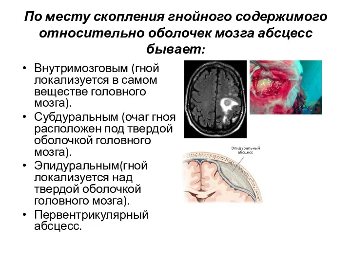 По месту скопления гнойного содержимого относительно оболочек мозга абсцесс бывает: Внутримозговым (гной локализуется