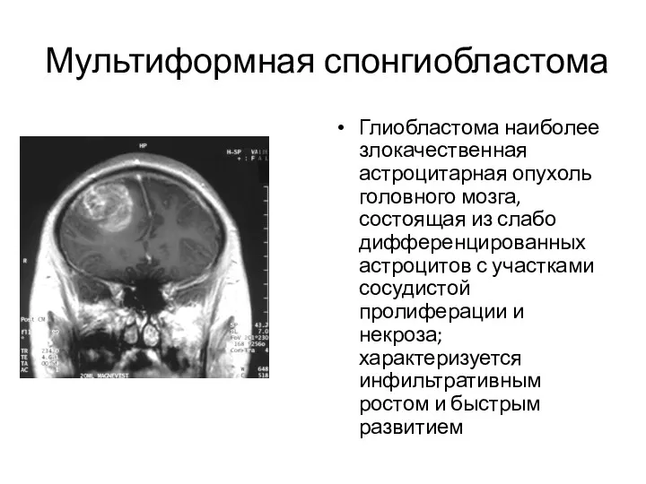 Мультиформная спонгиобластома Глиобластома наиболее злокачественная астроцитарная опухоль головного мозга, состоящая из слабо дифференцированных