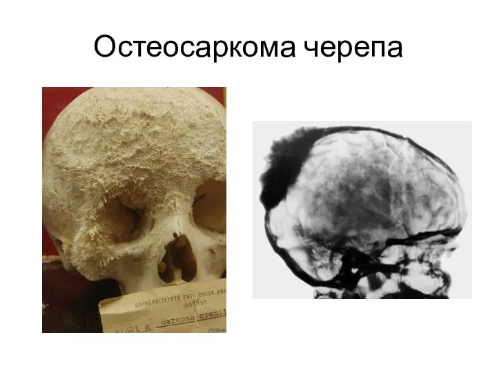 Остеосаркома черепа