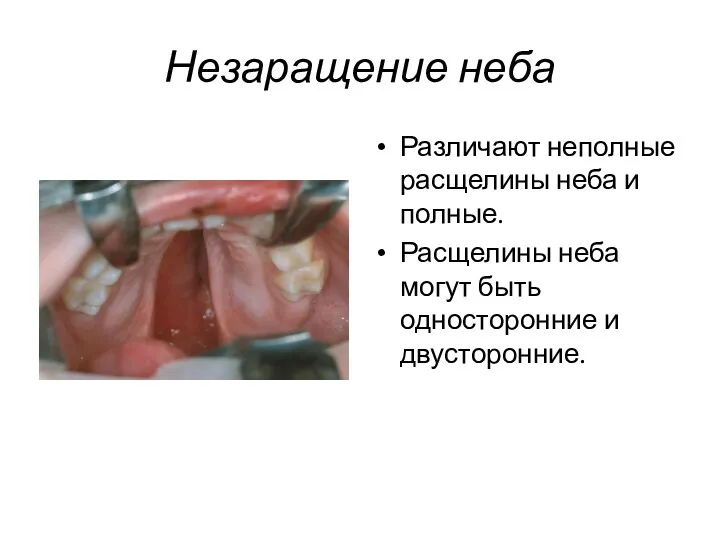 Незаращение неба Различают неполные расщелины неба и полные. Расщелины неба могут быть односторонние и двусторонние.