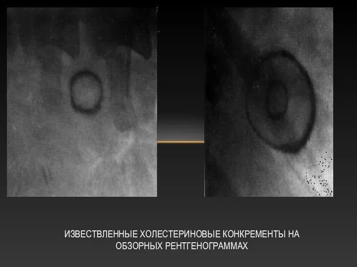 ИЗВЕСТВЛЕННЫЕ ХОЛЕСТЕРИНОВЫЕ КОНКРЕМЕНТЫ НА ОБЗОРНЫХ РЕНТГЕНОГРАММАХ