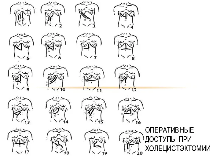 ОПЕРАТИВНЫЕ ДОСТУПЫ ПРИ ХОЛЕЦИСТЭКТОМИИ