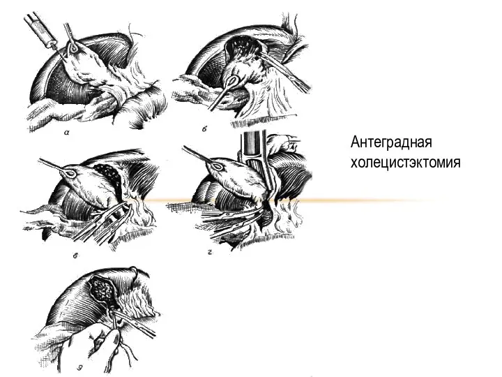 Антеградная холецистэктомия