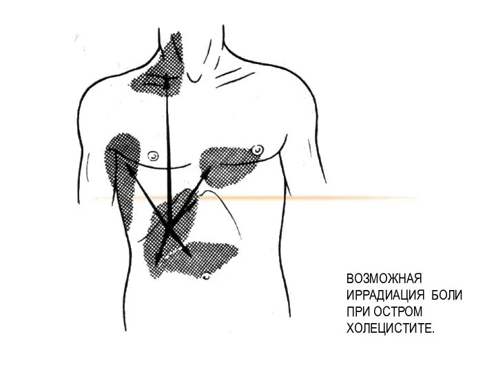 ВОЗМОЖНАЯ ИРРАДИАЦИЯ БОЛИ ПРИ ОСТРОМ ХОЛЕЦИСТИТЕ.