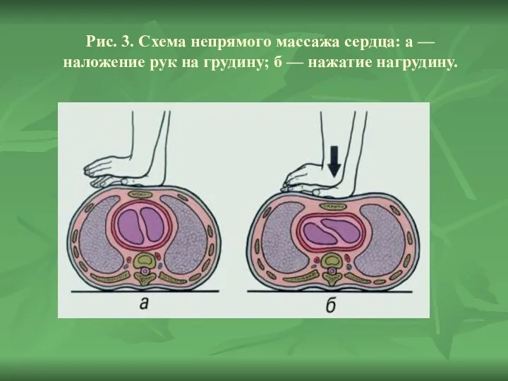 Рис. 3. Схема непрямого массажа сердца: а — наложение рук на грудину; б — нажатие нагрудину.