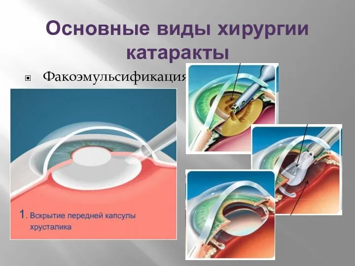 Основные виды хирургии катаракты Факоэмульсификация